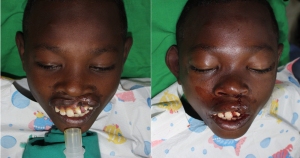 Mohamed Before and After Surgery
